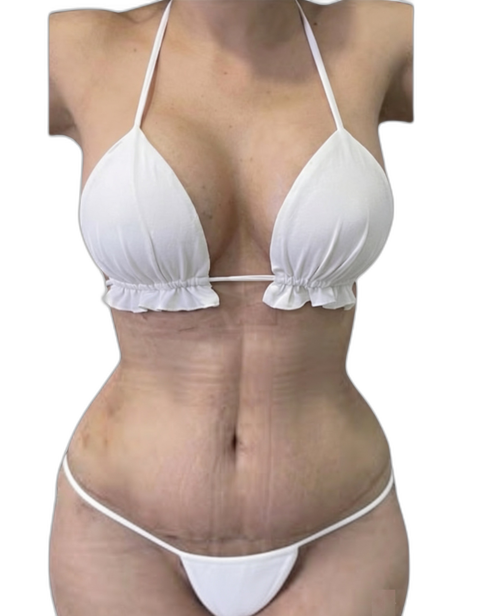 Resultado de Mommy Makeover — Dr. Jesús E. Chung